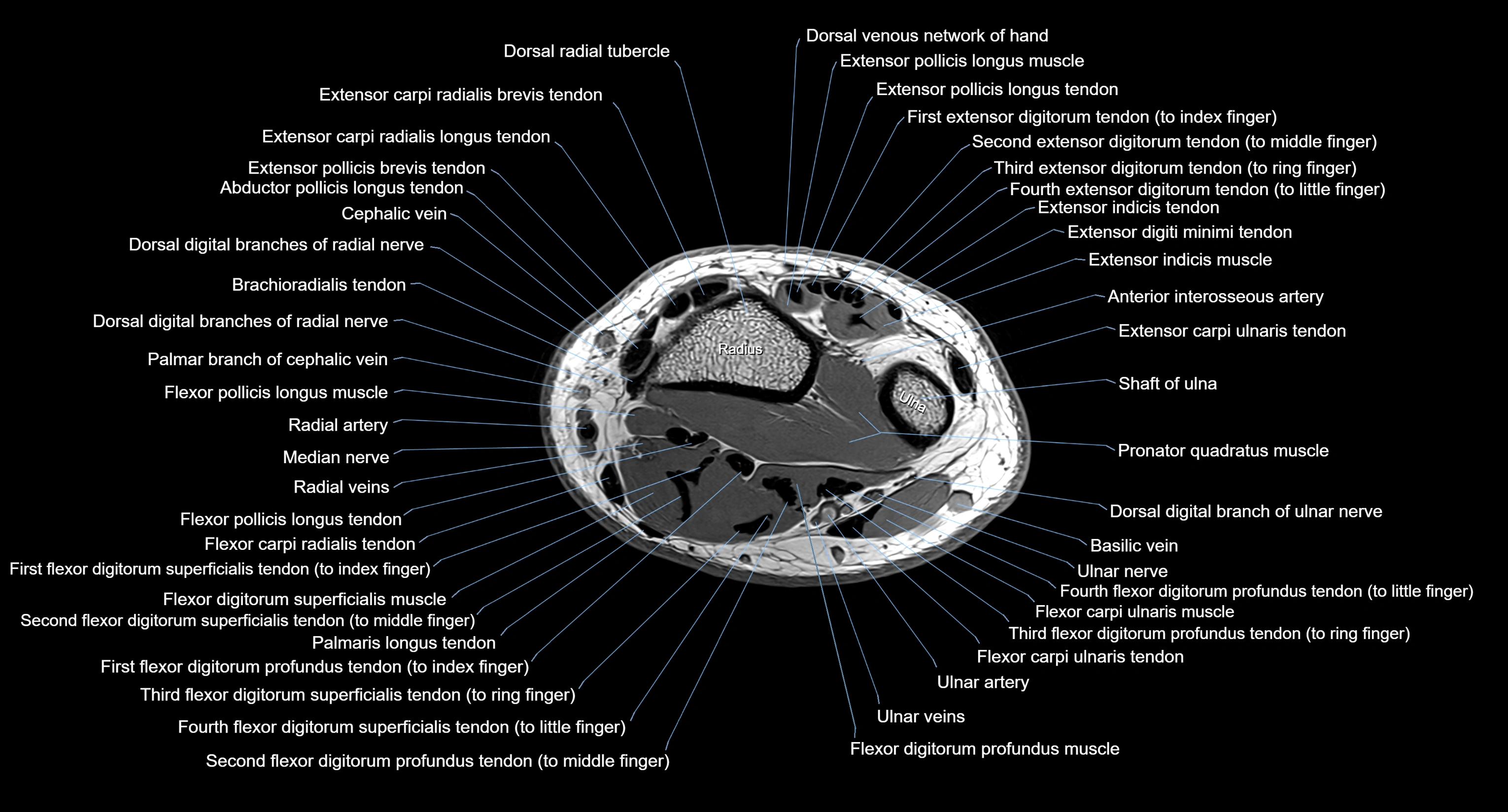 MRI wrist axial cross sectional anatomy 3T radiology  image-img-00001-00033.webp